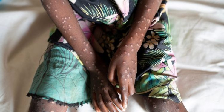 Mpox outbreak declared public health emergency in Africa