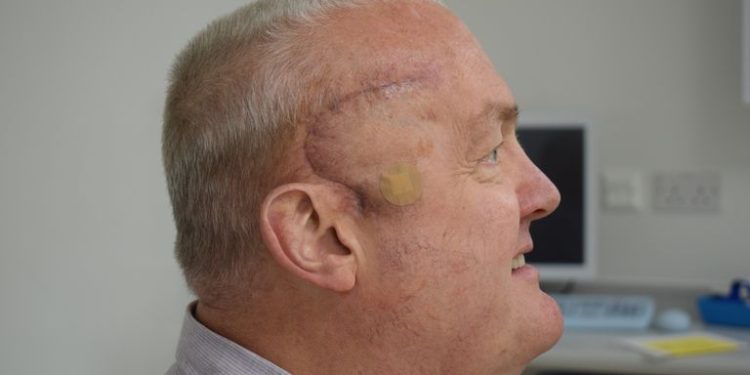 New cancer treatment trial shrinks Luton man’s brain tumour by half after just weeks of radioactive injections